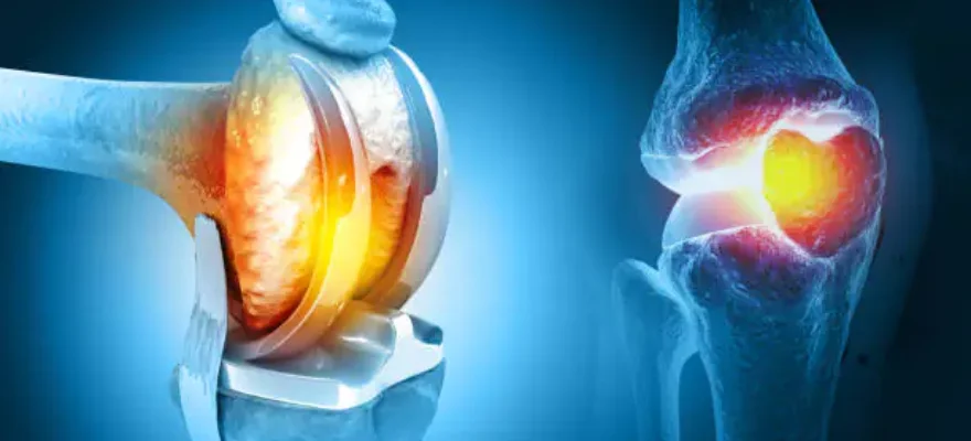 Artrose de Joelho: Quando a Prótese é Necessária?